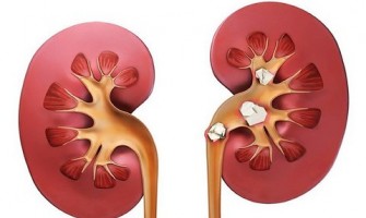 ماده موثر در ایجاد سنگ‌ کلیه و مثانه با نانوحسگر