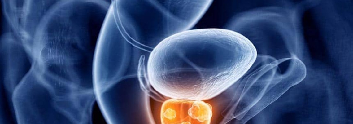 تولید نانو حامل‌ داروی سرطان پروستات