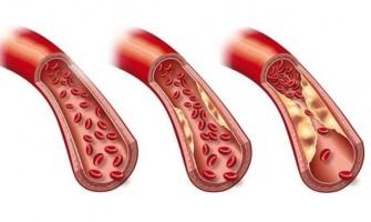 تری گلسیرید